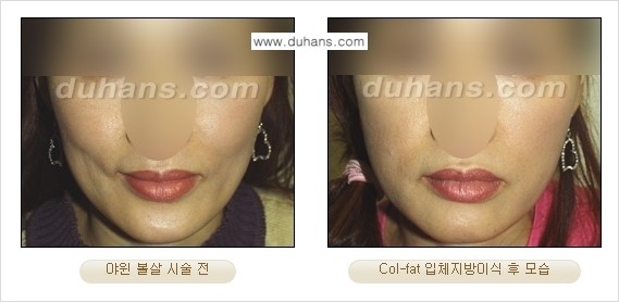 [두한성형외과 경쟁력 미세지방이식]-[Col-fat 입체지방이식 사례 안내] 관련 이미지 14