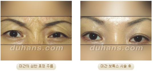 ​[두한성형외과 안티에이징] - [보톡스, 필러, 지방이식을 이용한 주름개선] 관련 이미지 7