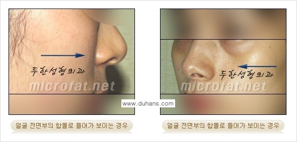 [두한성형외과의 경쟁력 미세지방이식] - [귀족수술과 인디언밴드 미세지방이식 안내 ①] 관련 이미지 2