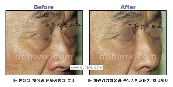 [두한성형외과의 상큼하고 환한 젊은 눈매완성] - [하안검 성형술 ①] 관련 이미지 27