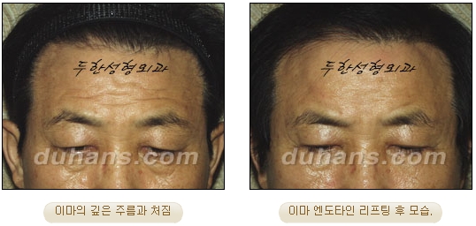 두한성형외과 안티에이징 리프팅 - 엔도타인 리프팅 관련 이미지 28