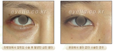 [Duhan Plastic Surgery Eyelid Surgery] - [Epicanthoplasty, Medial Canthoplasty] image 4