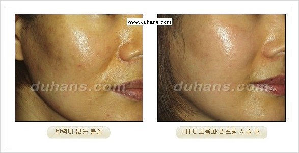 [두한성형외과 경쟁력 주름성형] - [HIFU 초음파 리프팅 주름교정술 안내 2.] 관련 이미지 25