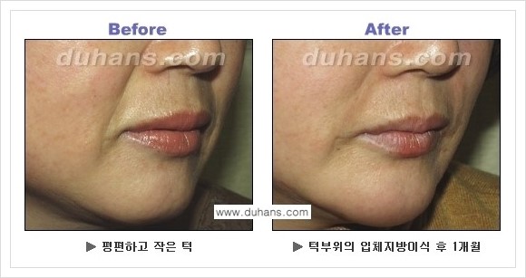 [두한성형외과 경쟁력 미세지방이식] - [아름다운 얼굴선 - 무턱, 오목턱, 비대칭턱 지방이식 안내] 관련 이미지 5