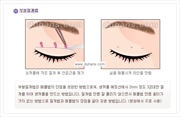 [두한성형외과 경쟁력 눈성형] - [아름다운 눈매를 쌍꺼풀수술 안내 ①] 관련 이미지 6