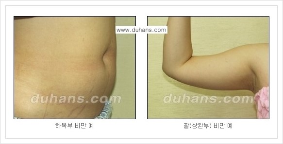 [두한성형외과 경쟁력 초음파 간편지방흡입] - [복부지방흡입, 허벅지지방흡입, 엉덩이지방흡입, 팔뚝지방흡입 안내] 관련 이미지 5
