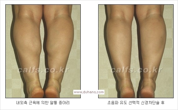 ⁠[두한성형외과 경쟁력 종아리성형] - [종아리퇴축술 - 비절개 초음파 유도 선택적 신경차단술 장비 안내] 관련 이미지 8