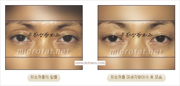 [두한성형외과 Dr. 컬럼] - [눈꺼풀의 지방이식] 관련 이미지 9