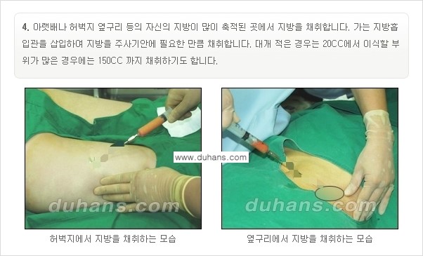 [두한성형외과 경쟁력 미세지방이식] - [부드럽고 아름다운 얼굴선 얼굴 미세지방이식 과정] 관련 이미지 4