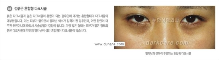 [두한성형외과 NO.1 경쟁력] - [원인과 색에 따른 다크써클의 종류] 관련 이미지 9