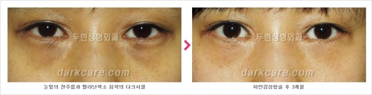 ​[두한성형외과 경쟁력 눈밑성형 리더] - [눈밑 다크써클의 증상, 원인, 종류, 치료방법 안내] 관련 이미지 65