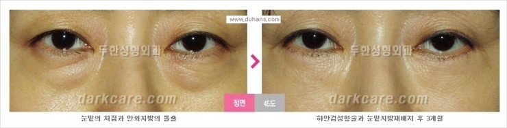[두한성형외과 경쟁력 눈밑성형] - [눈밑 지방재배치의 문제점 안내] 관련 이미지 6