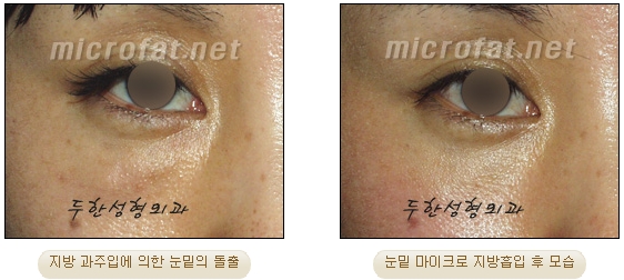 [Duhan Plastic Surgery Liposuction] - [Facial Liposuction] image 26