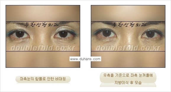 [두한성형외과 경쟁력 눈성형] - [미세지방이식으로 비대칭 쌍꺼풀 라인의 교정 방법 안내] 관련 이미지 6