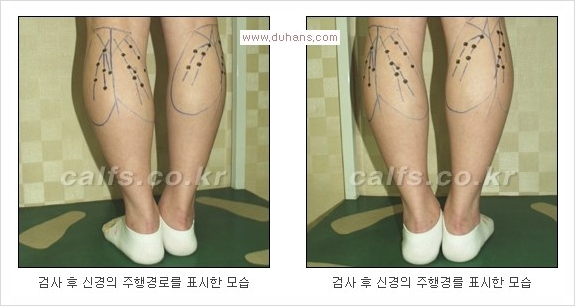 ⁠⁠[두한성형외과 경쟁력 종아리성형] - [굵은 다리의 모양과 원인에 따른 종아리성형 방법] 관련 이미지 4