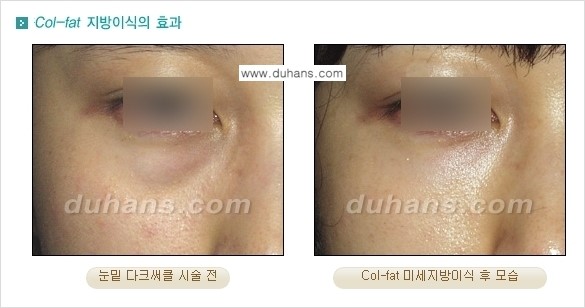 [두한성형외과 경쟁력 미세지방이식]-[Col-fat 입체지방이식 사례 안내] 관련 이미지 2