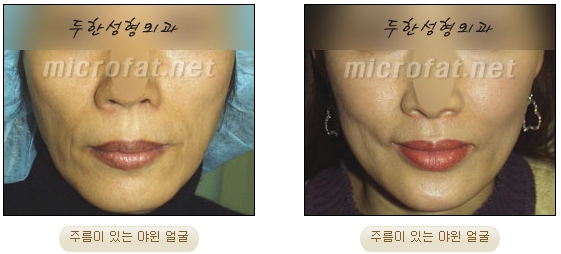 [DuHan Plastic Surgery Face Fat Grafting] - [Cheek Fat Grafting] image 2