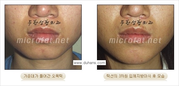 [두한성형외과 경쟁력 미세지방이식] - [얼굴 윤곽 무턱교정 안내 ②] 관련 이미지 6