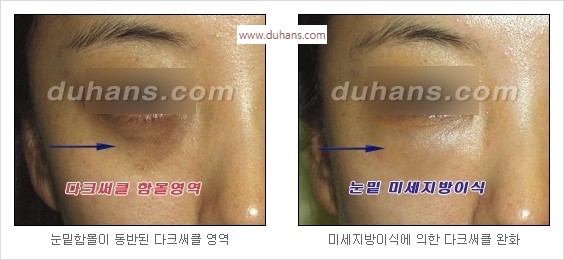 [두한성형외과 경쟁력 안검성형] - [젊은 눈매 안검성형의 여러 가지 방법 안내] 관련 이미지 68