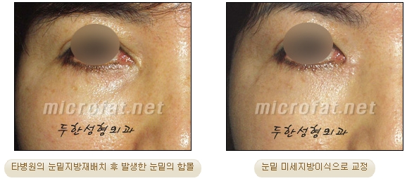 [두한성형외과 지방제거] - [눈밑지방제거, 윗눈꺼풀지방제거] 관련 이미지 51