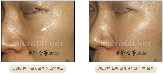 [Duhan Plastic Surgery Face Autologous Fat Grafting] - [Noble Surgery and Indian Band Fat Grafting] image 28