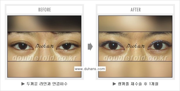 [두한성형외과 쌍꺼풀 재수술] - [눈매교정이 과한 경우의 문제] 관련 이미지 2