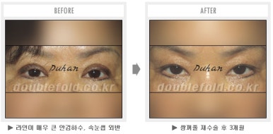 두한성형외과 쌍커풀 재수술 - 짝눈 눈매교정, 가성 안검하수 교정과 뒤밑트임 관련 이미지 51