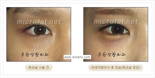 [두한성형외과 경쟁력 눈밑성형] - [눈밑 애교살 미세지방이식 안내] 관련 이미지 4