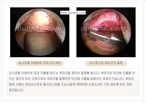 [두한성형외과 경쟁력 주름성형] - [엔도타인 리프팅 안내 ②] 관련 이미지 12