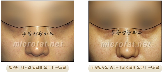 [두한성형외과 지방이식] - [다크서클, 눈밑주름] 관련 이미지 4