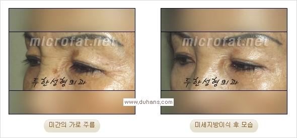 [두한성형외과 경쟁력 주름성형] - [주름 교정을 위한 안전하고 효과적인 미세지방이식] 관련 이미지 7