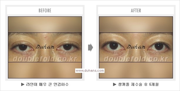 [두한성형외과 쌍꺼풀 재수술, 극한 눈재수술] - [재수술에 대한 자주하는 질문과 답변 안내] 관련 이미지 3
