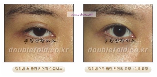 [두한성형외과 경쟁력 쌍꺼풀 재수술] - [풀린 라인 교정(Correction released fold line) 방법] 관련 이미지 4