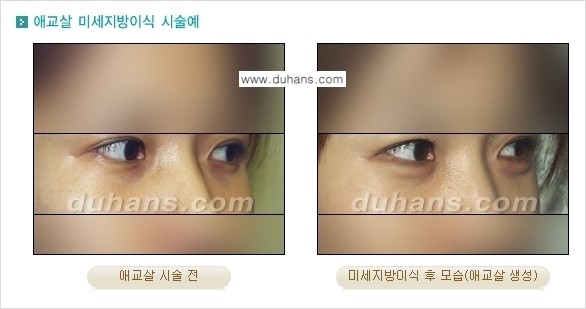 [두한성형외과 경쟁력 미세지방이식] - [눈밑 애교살을 위한 미세지방이식 1.] 관련 이미지 5