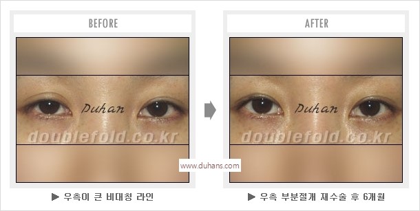 [두한성형외과 경쟁력 눈성형] - [나에게 맞는 어울리는 쌍꺼풀 라인] 관련 이미지 42