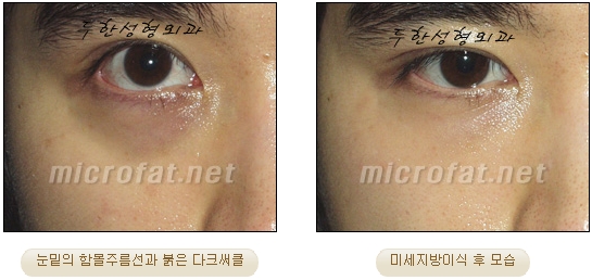 Fat Grafting Leader Duhan Plastic Surgery - Everything About Fat Grafting image 46