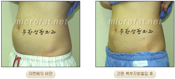두한성형외과 지방흡입 - 부위별 안전 지방흡입 관련 이미지 12