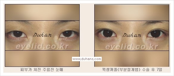 [두한성형외과 경쟁력 눈성형] - [퀵쌍꺼풀(부분절개법) 안내] 관련 이미지 8