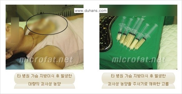 [두한성형외과 경쟁력 미세지방이식] - [타병원에서의 미세지방이식 이후 부작용 교정의 대상 안내] 관련 이미지 10