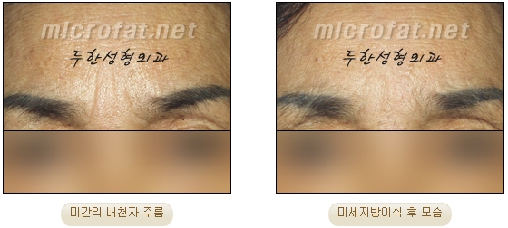 [두한성형외과 자가지방이식] - [미간주름] 관련 이미지 13