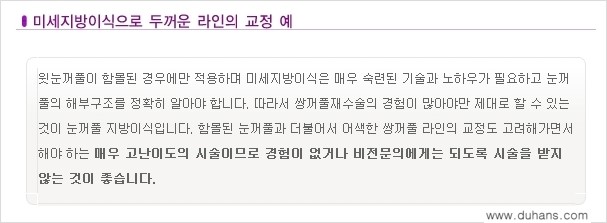 [두한성형외과 NO.1 눈성형] - [함몰된(꺼진) 눈꺼풀에서 쌍꺼풀 라인 교정 2.] 관련 이미지 4