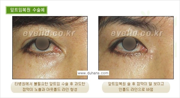 [두한성형외과 성형 FOCUS] - [앞트임 복원수술] 관련 이미지 4