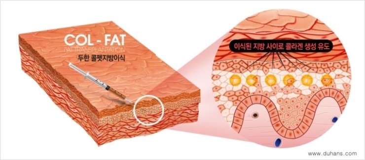 [두한성형외과 FOCUS 눈밑성형] - [다크써클의 치료방법 -  콜펫(Col-fat) 눈밑 미세지방이식 ③] 관련 이미지 5