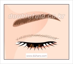 [두한성형외과 경쟁력 눈성형] - [쌍꺼풀 재수술 실패의 원인과 문제점] 관련 이미지 10