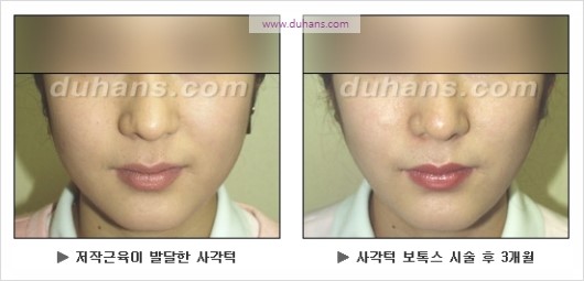 [두한성형외과 경쟁력 안면윤곽 성형 리더] - [완변한 V 라인! 턱 미세지방이식, 볼살 미세지방이식, 사각턱 보톡스 안내] 관련 이미지 42