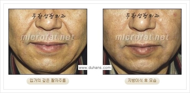 [두한성형외과 경쟁력 미세지방이식] - [입가주름, 팔자주름 교정 안내] 관련 이미지 8