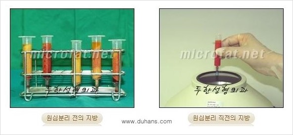 ​[두한성형외과 경쟁력 지방이식] - [지방이식 부작용 이후 마이크로 지방흡입, 마이크로 지방흡입 이후 부작용 없는 지방이식 방법] 관련 이미지 12