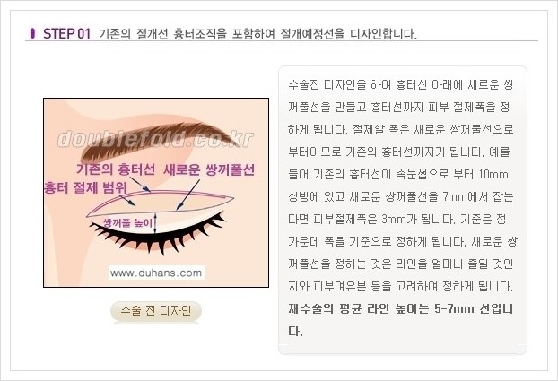 [두한성형외과 경쟁력 쌍꺼풀 재수술, 극한 재수술] - [쌍꺼풀 재수술의 과정 안내 1.] 관련 이미지 1