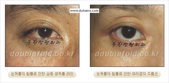 [두한성형외과 경쟁력 눈성형] - [삼중(세겹) 쌍꺼풀 라인의 교정] 관련 이미지 12