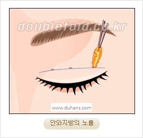 [두한성형외과 경쟁력 눈성형] - [자연스럽고 아름다운 눈매를 만드는 여러 가지 눈성형 방법] 관련 이미지 8